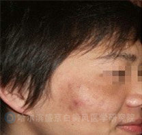 脸部白癜风患者康复案例图片
