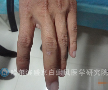手指白斑症状图片