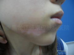 白癜风不是一道跨不去的坎,她积极